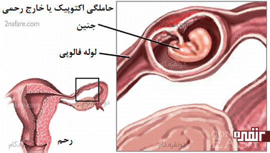 حاملگی نابجا، اکتوپیک یا خارج رحمی