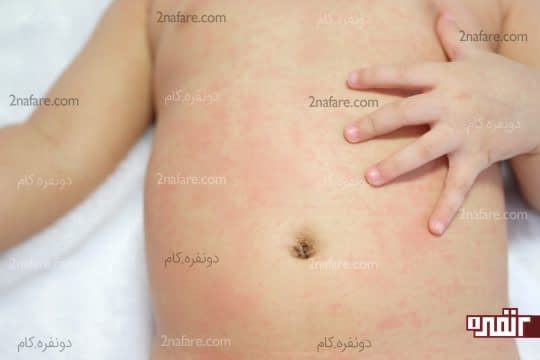 مننژیت از عوارض عفونت گوش کودکان