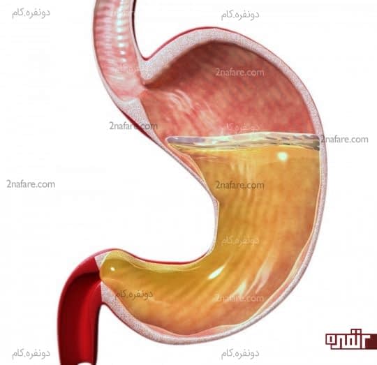 وجود اسید بیش از حد معده