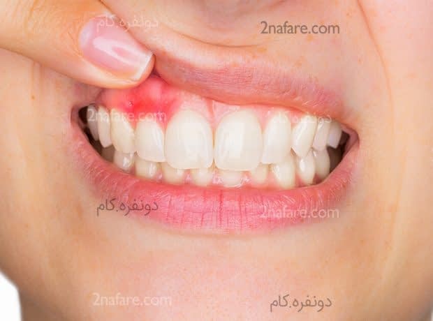 ۱۰ درمان خانگی برای خونریزی لثه خونریزی لثه