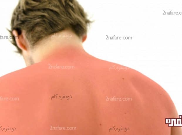 7 درمان خانگی برای آفتاب سوختگی درمان خانگی آفتاب سوختگی