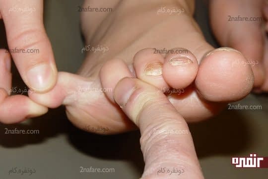 قارچ لای انگشتان پای ورزشکار