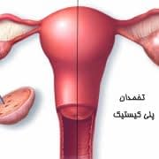 کیست تخمدان چیست و چه عوارضی دارد