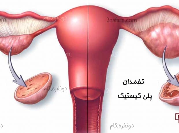 کیست تخمدان چیست و چه عوارضی دارد؟ کیست تخمدان چیست و چه عوارضی دارد
