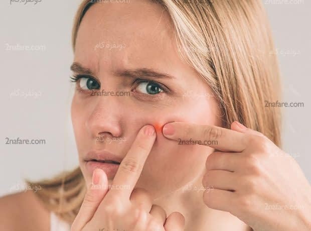چه غذاهایی باعث ایجاد آکنه میشن؟