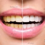 چند روش خانگی برای سفید کردن دندان ها