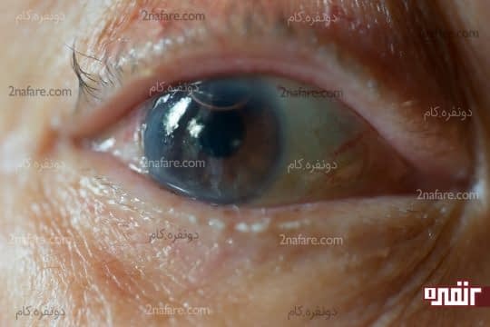 از آب مروارید جلوگیری می کند
