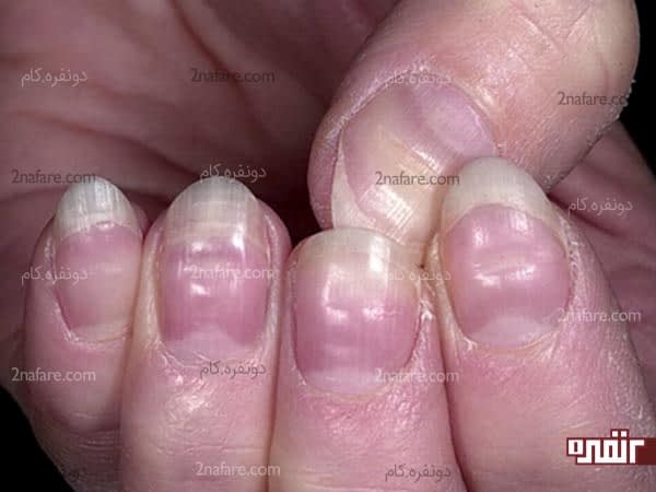 چطور لکه های سفید روی ناخن ها رو از بین ببریم؟ از بین بردن سفیدی روی ناخون ها