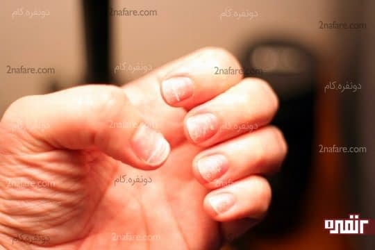 علائم لکه سفید روی ناخن