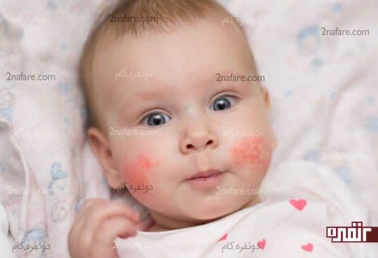 اگزما