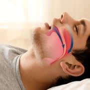 راهکارهای طبیعی درمان آپنه خواب